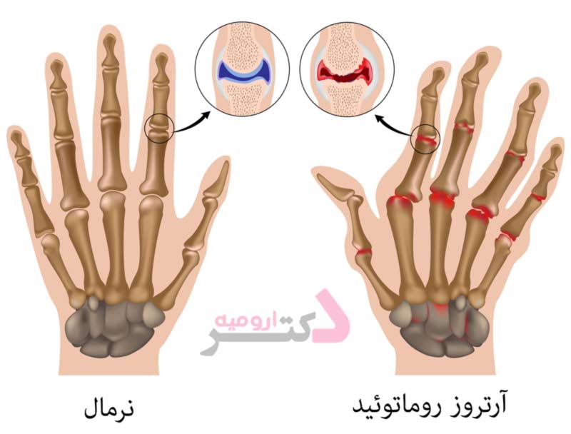 آرتروز در مفاصل دست و انگشتان