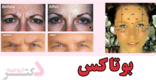 Botox in Urmia