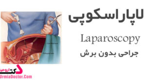 Laparoscopy-جراحی لاپاراسکوپی