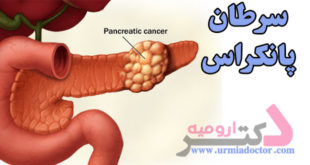 Pancreatic-Cancer