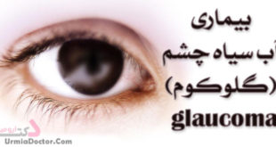 بیماری آب سیاه چشم glaucoma