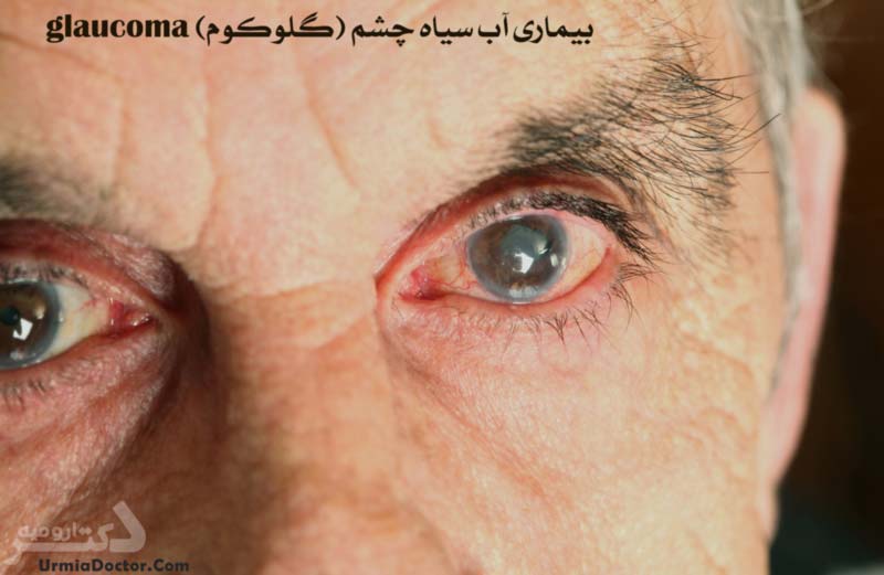 بیماری گلوکوم آب سیاه چشم و درمان آن