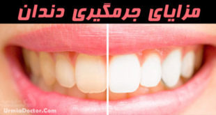 مزایای جرمگیری دندان