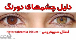 چشمهای دورنگ - اختلال هتروکرومی Heterochromia iridum