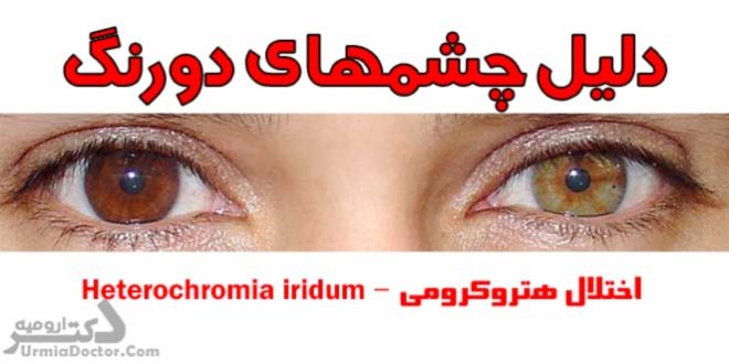 چشمهای دورنگ - اختلال هتروکرومی Heterochromia iridum