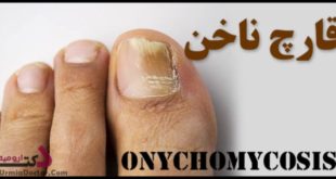 onychomycosis قارچ و عفونت ناخن