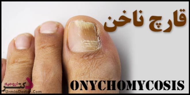 onychomycosis قارچ و عفونت ناخن