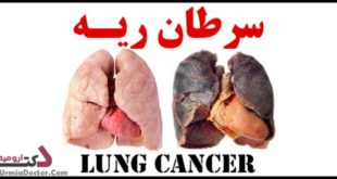 سرطان ریه چیست؟ Lung cancer