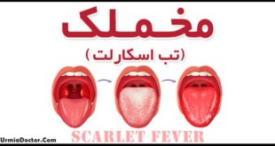 Scarlet fever بیماری مخملک یا تب اسکارلت