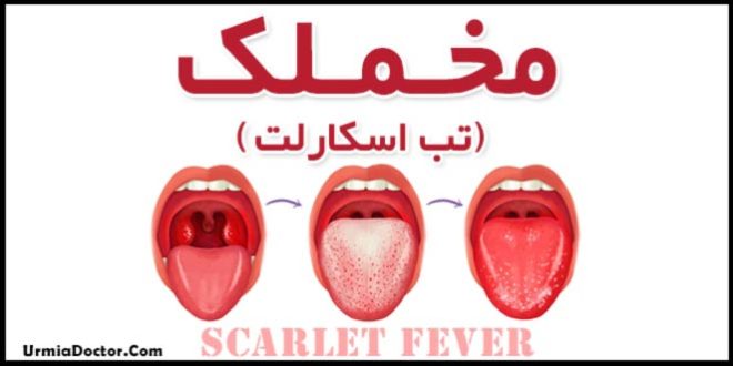 Scarlet fever بیماری مخملک یا تب اسکارلت