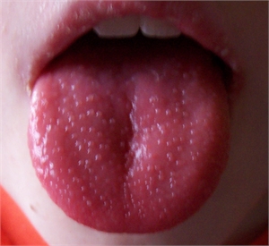 زبان توت فرنگی در بیماری مخملک