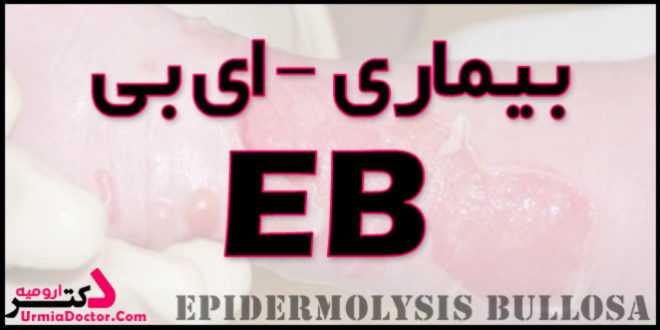 بیماری ای بی Epidermolysis bullosa
