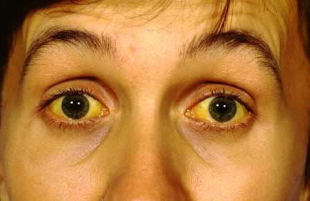زردی صلبیه چشم - سندروم ژیلبرت