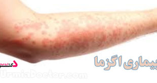 Eczema-disease