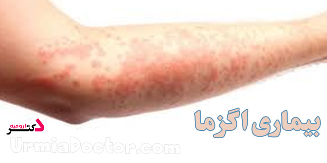 Eczema-disease