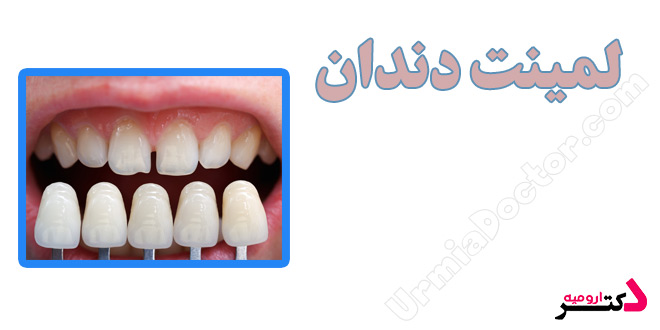 Tooth Lamination