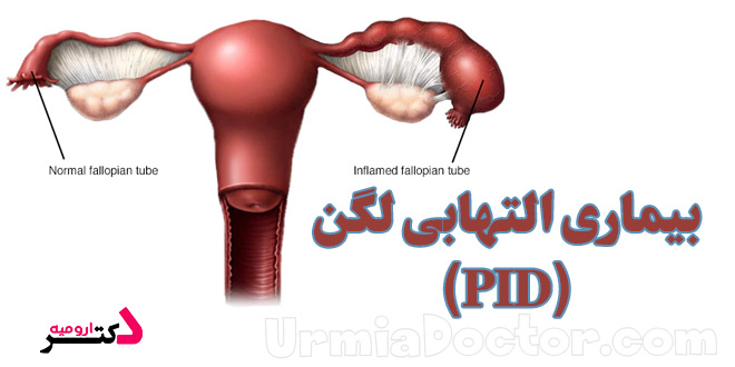 بیماری التهابی لگن(PID)