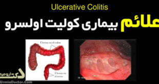 علائم بیماری کولیت اولسرو Ulcerative colitis signs