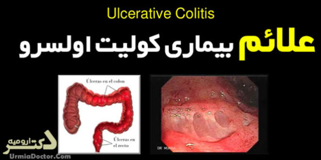 علائم بیماری کولیت اولسرو Ulcerative colitis signs