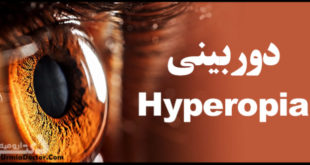 دوربینی یا هیپروپی Hyperopia
