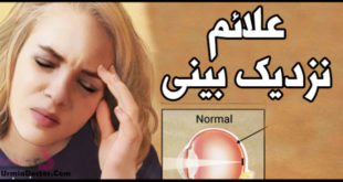 علائم نزدیک بینی myopia signs
