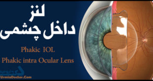 لنز داخل چشمی Phakic IOL