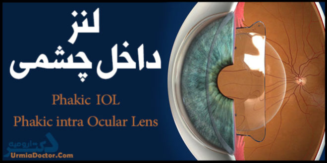 لنز داخل چشمی Phakic IOL