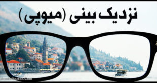 نزدیک بینی - میوپی Myopia