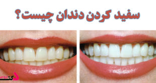 whitening teeth