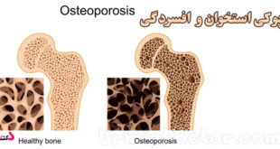 Osteoporosis and depression