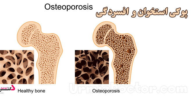 Osteoporosis and depression