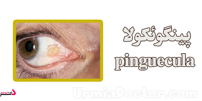 بیماری پینگوئکولا pinguecula