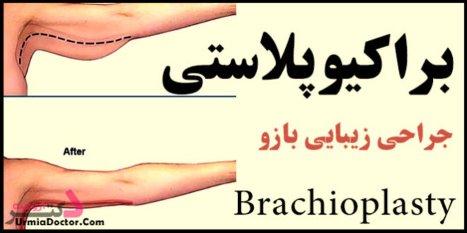براکیوپلاستی عمل زیبایی بازو Brachioplasty
