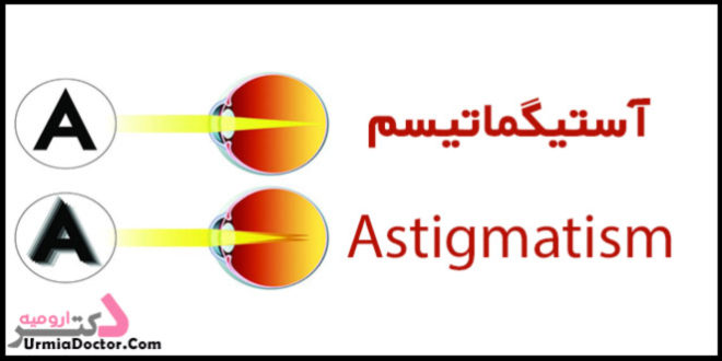 Astigmatism آستیگماتیسم