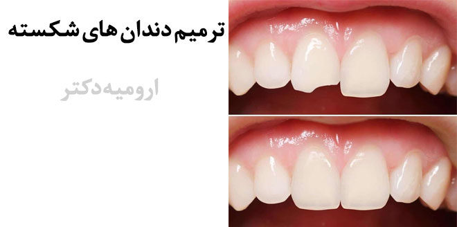 Broken teeth repair
